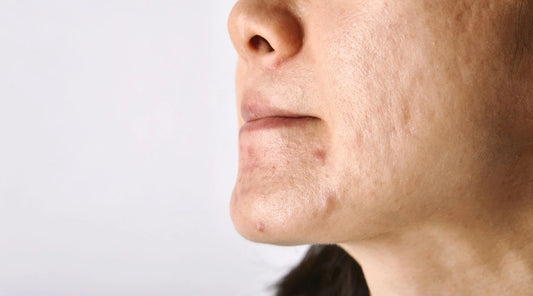 How to Remove Acne Scars Naturally in a Week: Effective Home Remedies