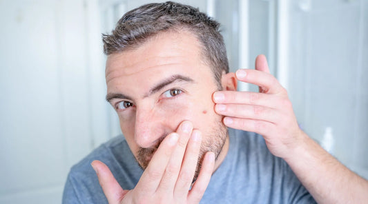 The Ultimate Guide to Pimple Popping: Say Goodbye to Blackheads