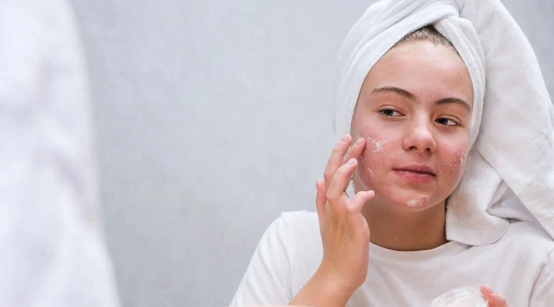 Best Moisturizer for Acne Prone Skin