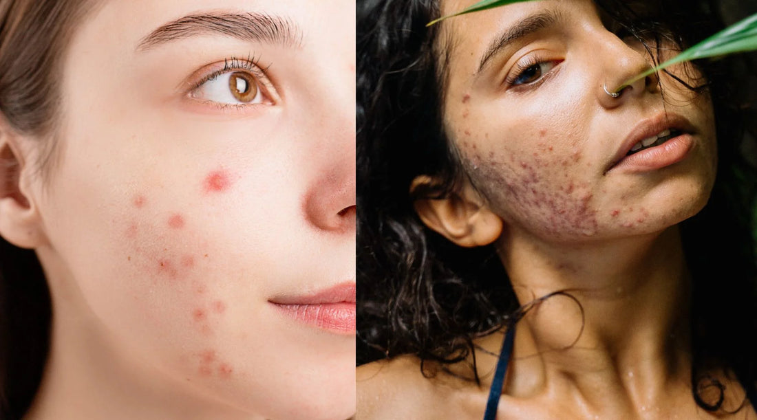 Difference Between Acne and Pimples: Unraveling the Mystery