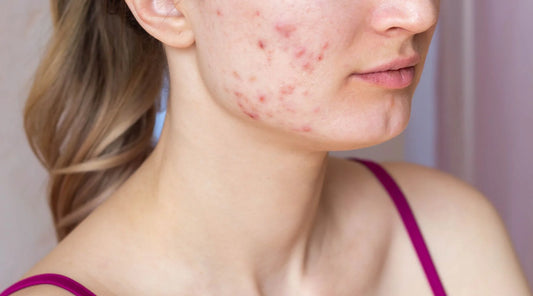 Best Acne Spot Treatment for Pimples: Your Ultimate Guide