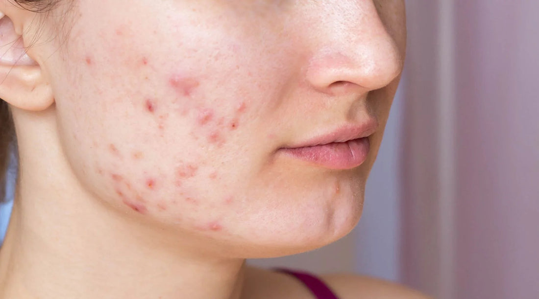 What is Cystic Acne? Understanding Severe Acne and Its Treatments