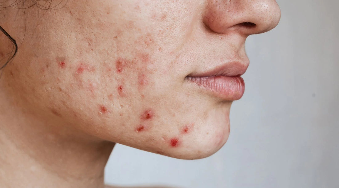 Cure Hormonal Acne Naturally