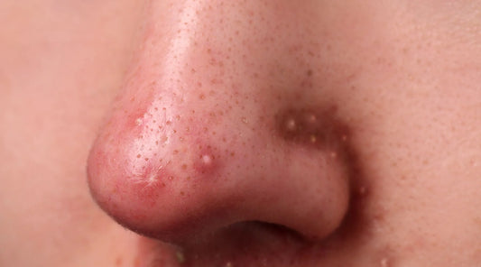 How to Get Rid of Pimples on Nose: Effective Tips and Treatments