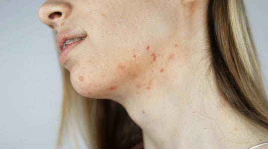 Cure Hormonal Acne Naturally: Effective and Proven Methods