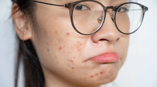 Inflamed Acne Treatment