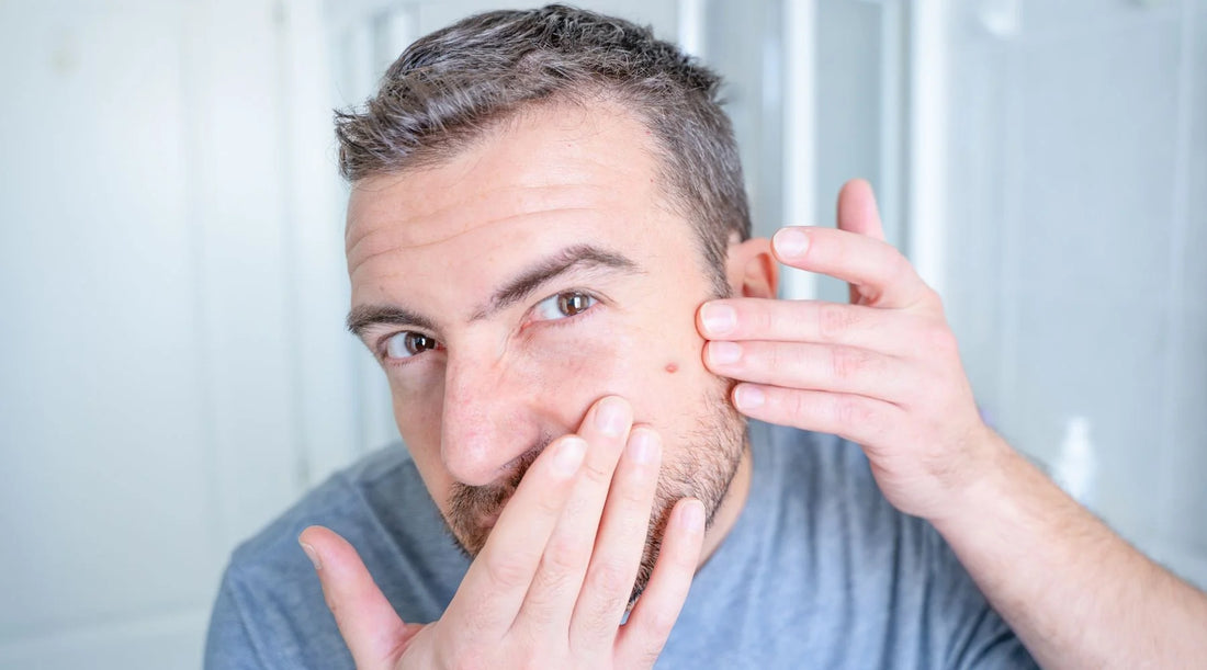 The Ultimate Guide to Pimple Popping: Say Goodbye to Blackheads