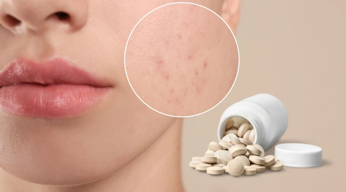 Understanding Spironolactone for Acne Treatment