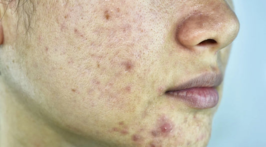 What is Fungal Acne? Understanding and Treating Malassezia Folliculitis